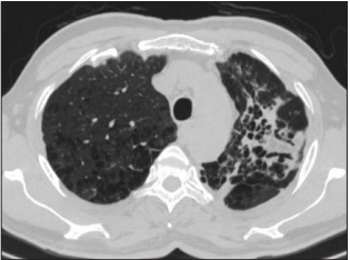 Benign Endobronchial Inflammatory Polyp with Cystic Degeneration: A Case Report